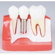 Implant Demonstration Training Model ( Red)